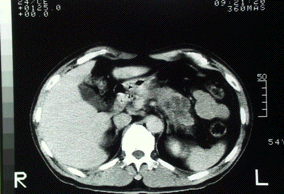 54歳男の膵臓体部癌症例 CT像