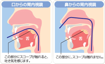 鼻からで苦痛が少ない経鼻内視鏡のしくみ